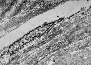F,42y. | pseudoangiomatous hyperplasia F,42y. | pseudoangiomatous hyperplasia